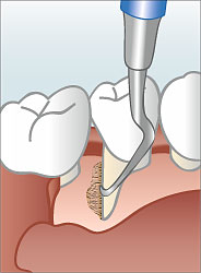 Bild 1 Ablauf einer Parodontalbehandlung