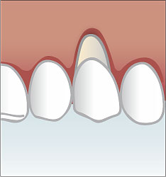 Rezession des Zahnfleisches mit freiliegender Wurzeloberfläche