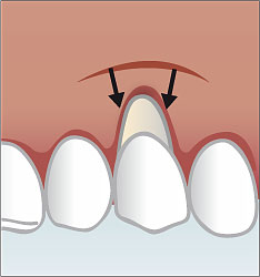 Nach Reinigung der Wurzeloberfläche wird das Zahnfleisch über eine spezielle Op-Technik in Richtung Zahnkrone verschoben und befestigt.