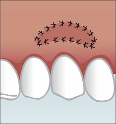 Zahnfleisch mit einem Schleimhauttransplantat
