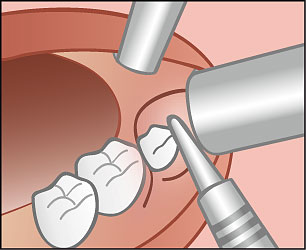 Nach operativer Freilegung der Zahnkrone folgt die chirurgische Entfernung des Zahnes.