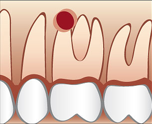 Wurzelspitze und umgebener Knochen des wurzelbehandelten Zahnes sind entzündet - oft bis an die Kieferhöhle heran.